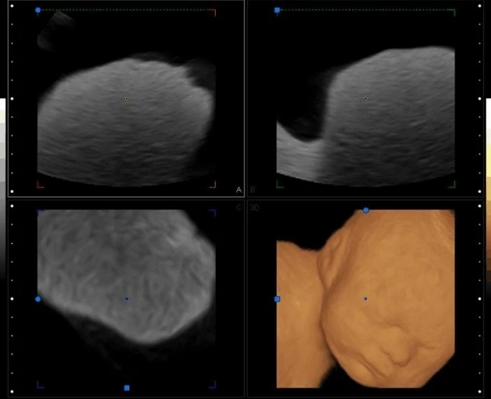 Portable-4D-Baby-Fetal-