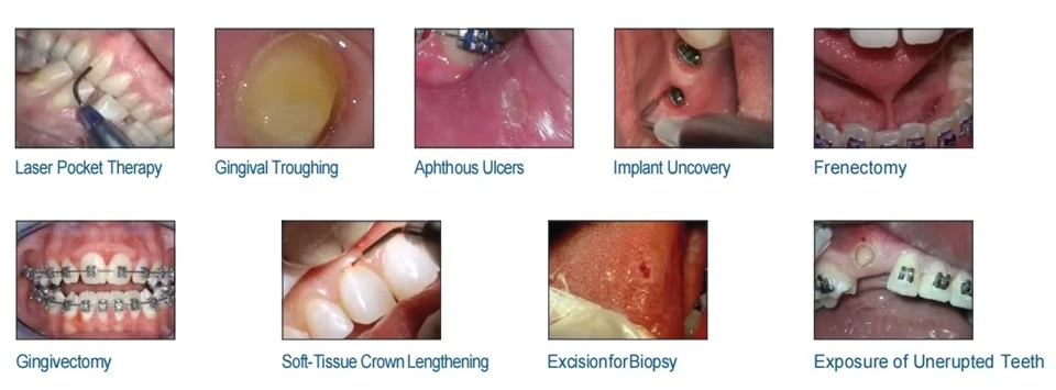Best Dental Diode Laser best Best Dental Diode Laser best